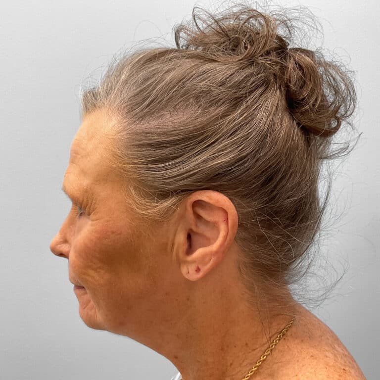 Before Image: Facelift – Dr. Tucker - left-side