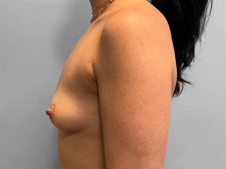 Before Image: Breast Augmentation – Dr. Tucker - left-side