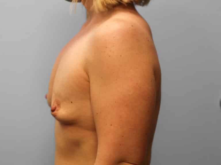 Before Image: Breast Augmentation – Dr. Tucker - left-side
