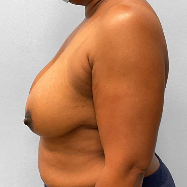 Before Image: Breast Augmentation – Dr. Tucker - left-side