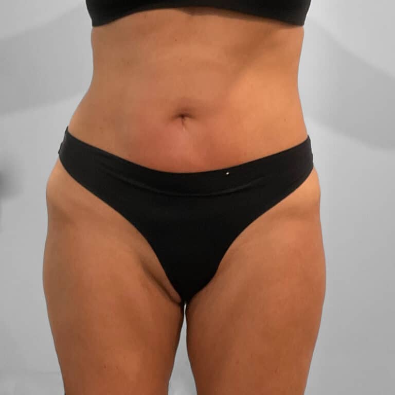 Before Image: Emsculpt Neo – Jessica - front