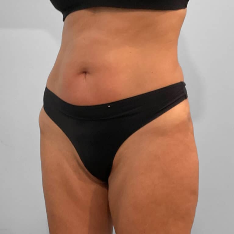 Before Image: Emsculpt Neo – Jessica - left-front-oblique