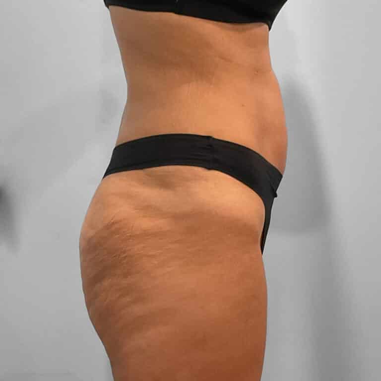 Before Image: Emsculpt Neo – Jessica - right-side