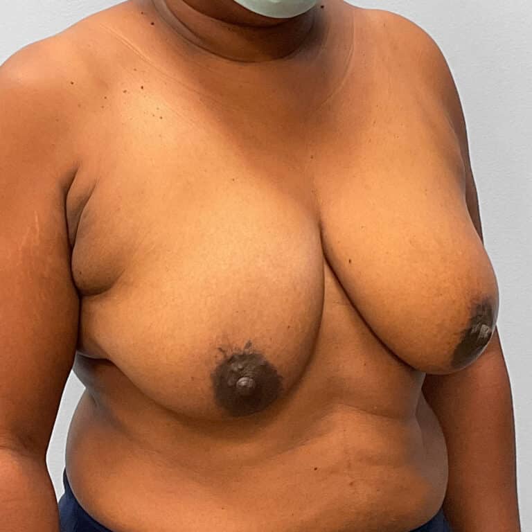 Before Image: Breast Augmentation – Dr. Tucker - right-front-oblique