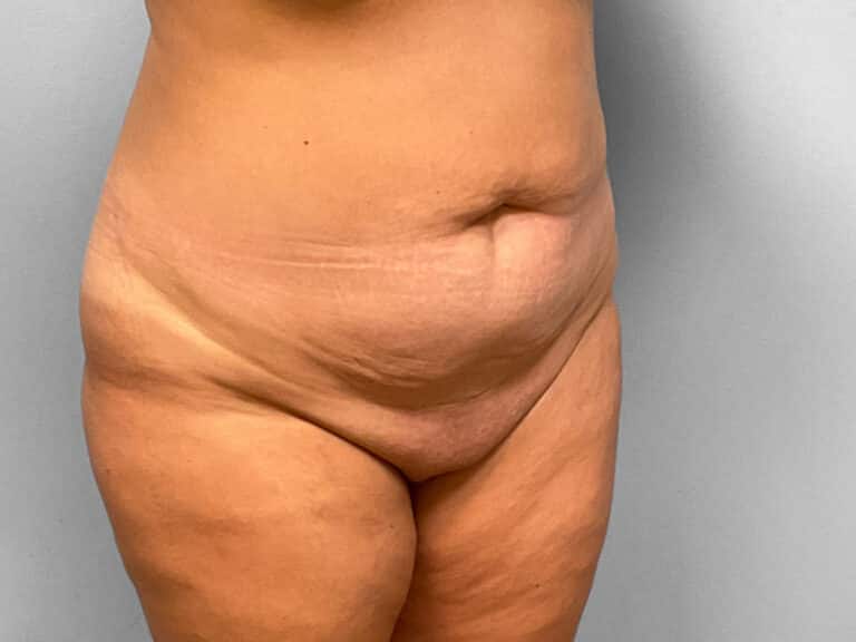 Before Image: Abdominoplasty & Lipo – Dr. Tucker - right-front-oblique