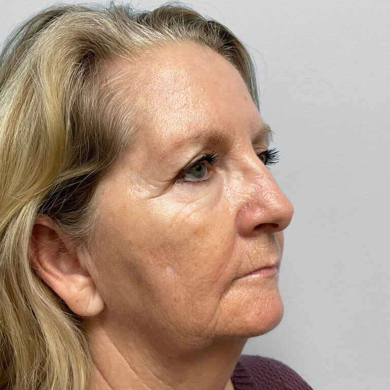 Before Image: Facelift, Blepharoplasty, TFX – Dr. Tucker - right-front-oblique