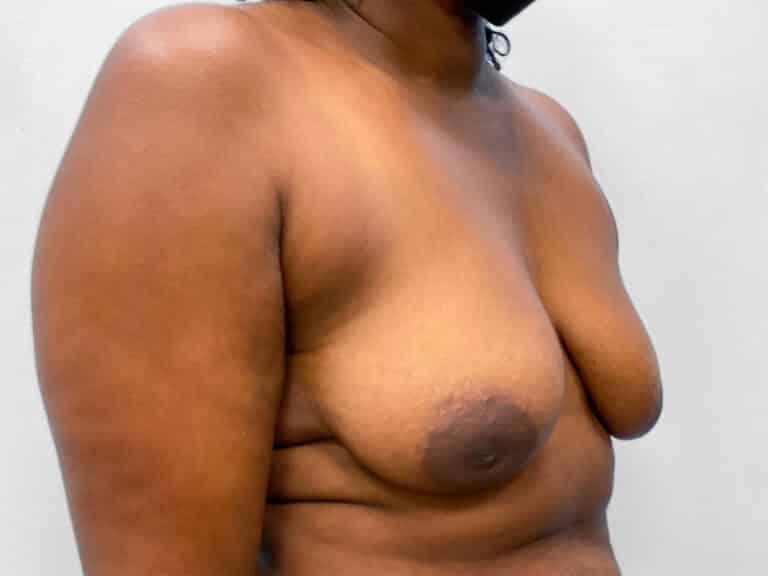 Before Image: Breast Augmentation & Lift – Dr. Tucker - right-front-oblique