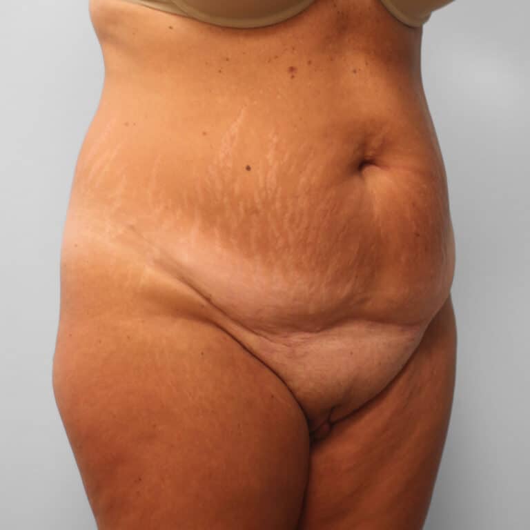 Before Image: Tummy Tuck & Lipo – Dr. Tucker - right-front-oblique