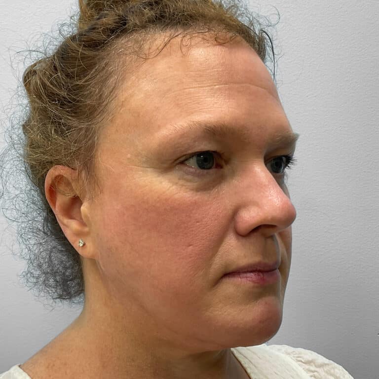 Before Image: Upper Blepharoplasty – Dr. Tucker - right-front-oblique