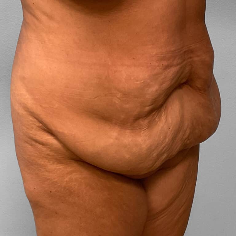 Before Image: Tummy Tuck & Lipo – Dr. Tucker - right-front-oblique