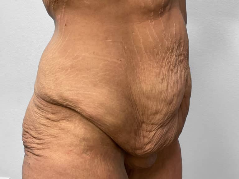 Before Image: Body Lift – Dr. Tucker - right-front-oblique
