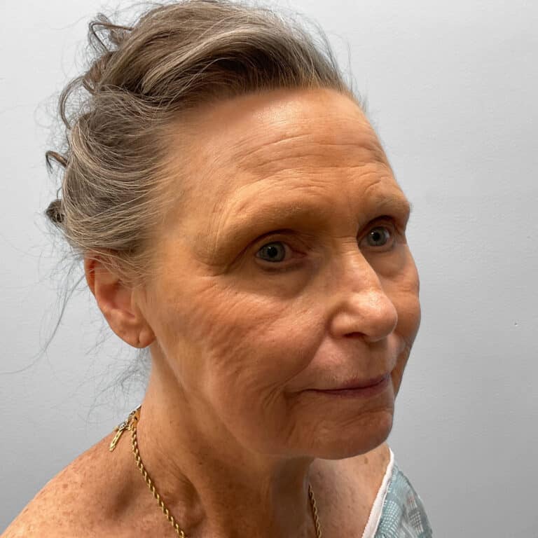 Before Image: Facelift – Dr. Tucker - right-front-oblique