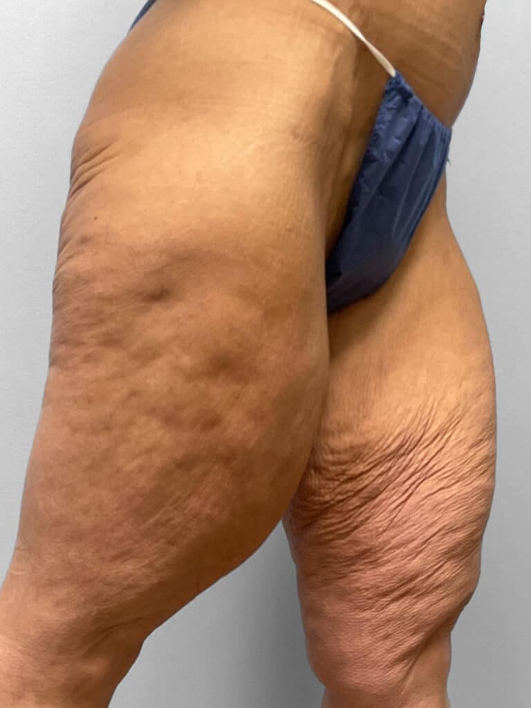 Before Image: Medial Thigh Lift – Dr. Tucker - right-front-oblique