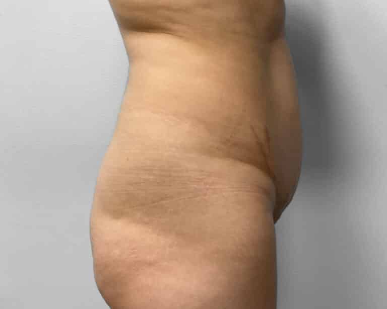 Before Image: Tummy Tuck, BBL, & Lipo – Dr. Tucker - right-side