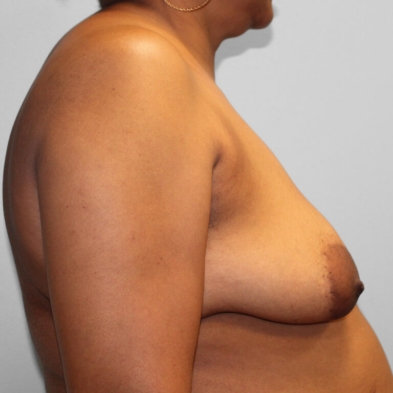 Before Image: Breast Reconstruction – Dr. Tucker - right-side