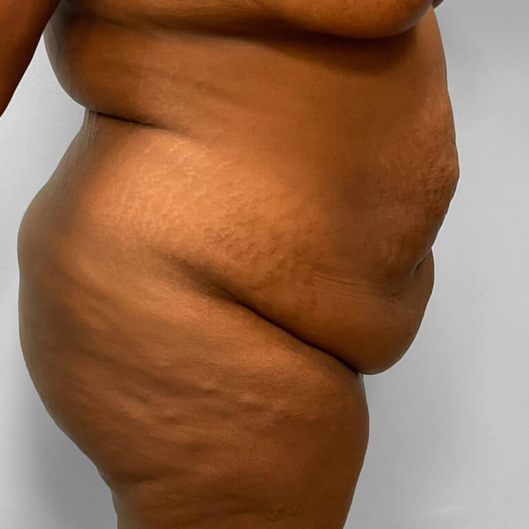 Before Image: Abdominoplasty & Lipo – Dr. Tucker - right-side