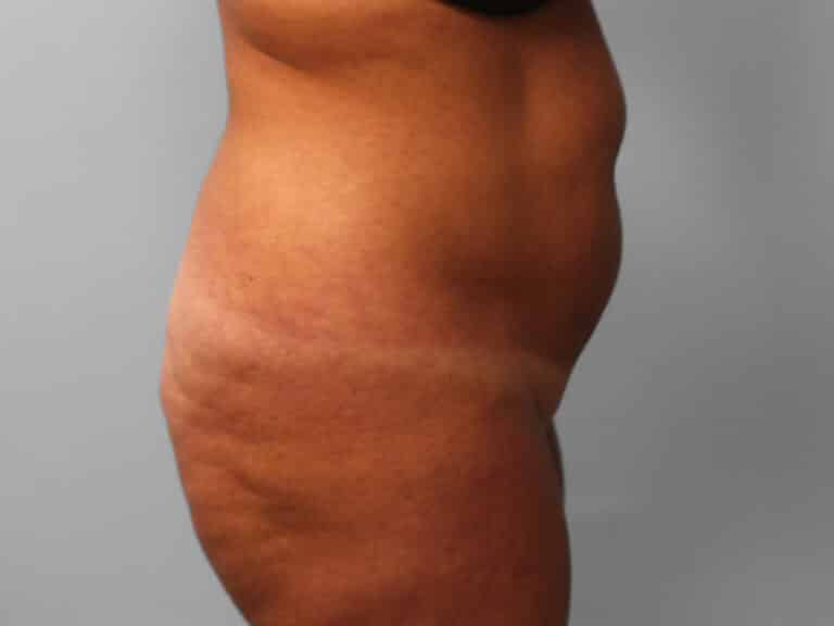Before Image: Abdominoplasty & Lipo – Dr. Tucker - right-side