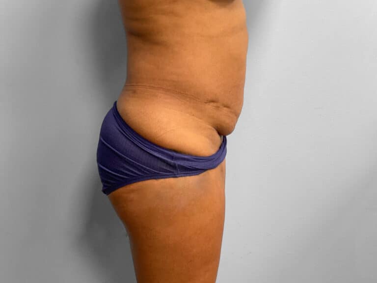 Before Image: Tummy Tuck & Lipo – Dr. Tucker - right-side