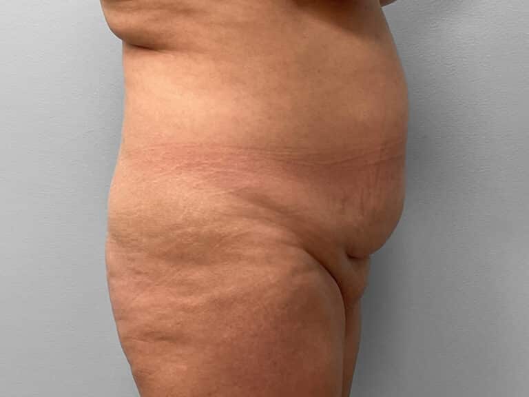 Before Image: Tummy Tuck & Lipo – Dr. Tucker - right-side