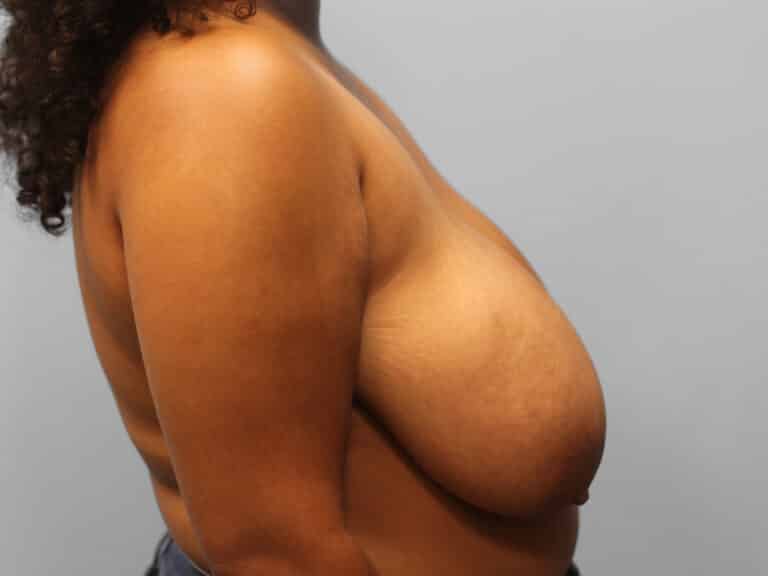 Before Image: Breast Reduction – Dr. Tucker - right-side