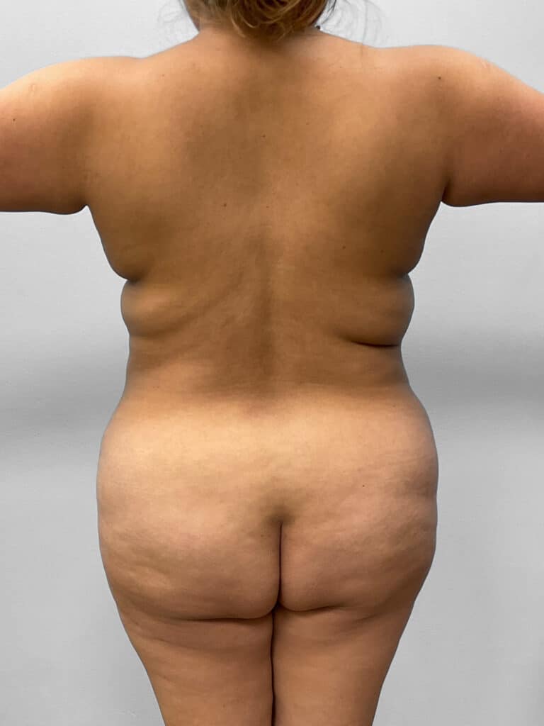 Before Image: Mommy Makeover – Dr. Tucker - back