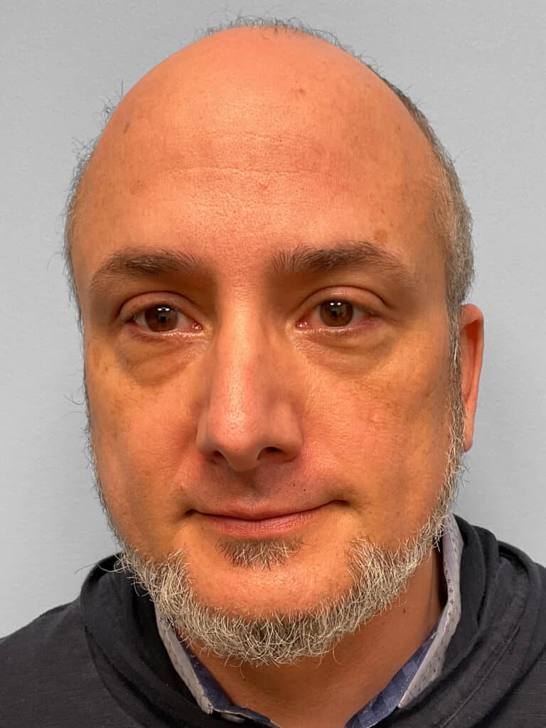 Before Image: Rhinoplasty – Dr. Tucker - front
