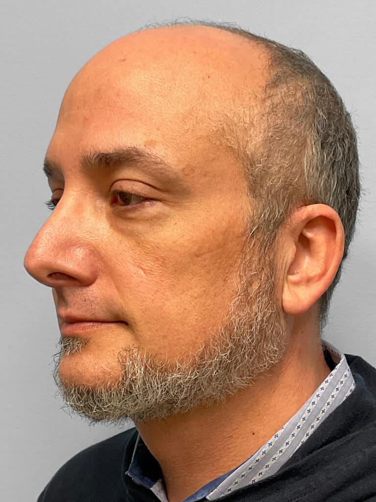 Before Image: Rhinoplasty – Dr. Tucker - left-front-oblique