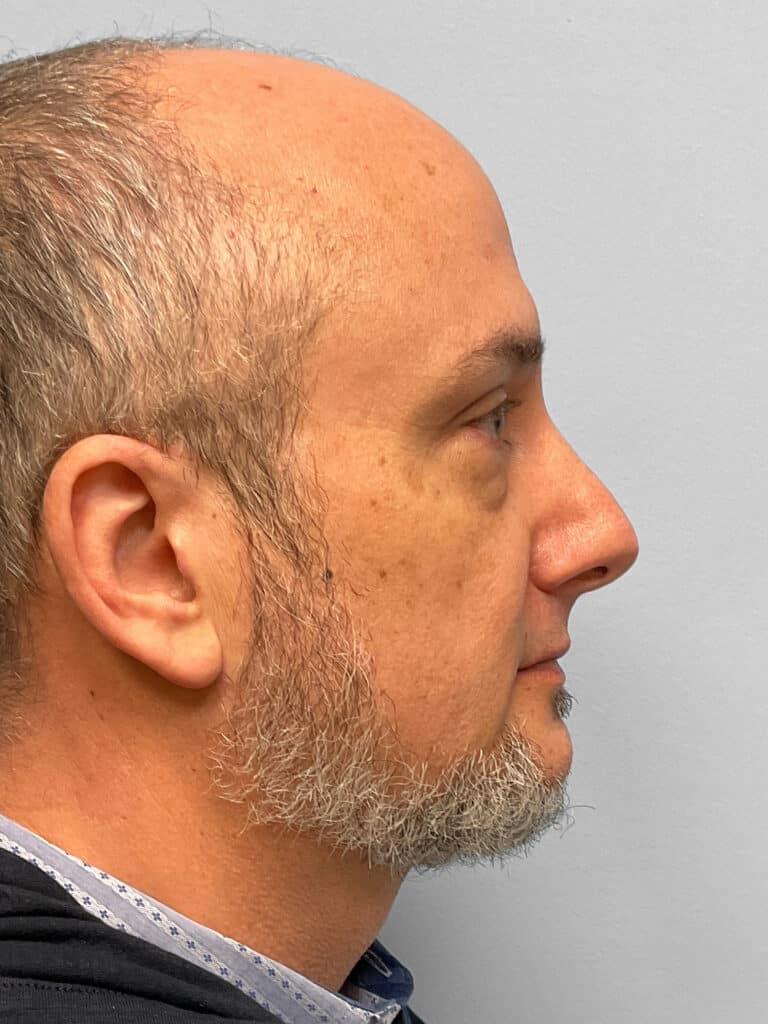 Before Image: Rhinoplasty – Dr. Tucker - right-side