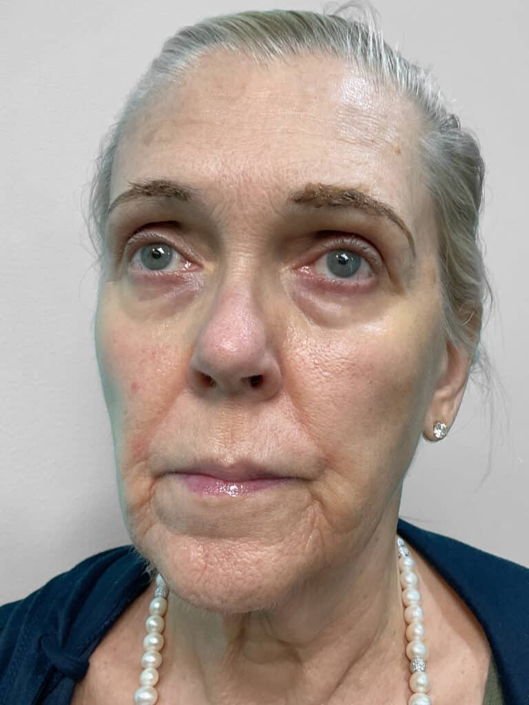 After Image: Injectables- Heather - left-front-oblique