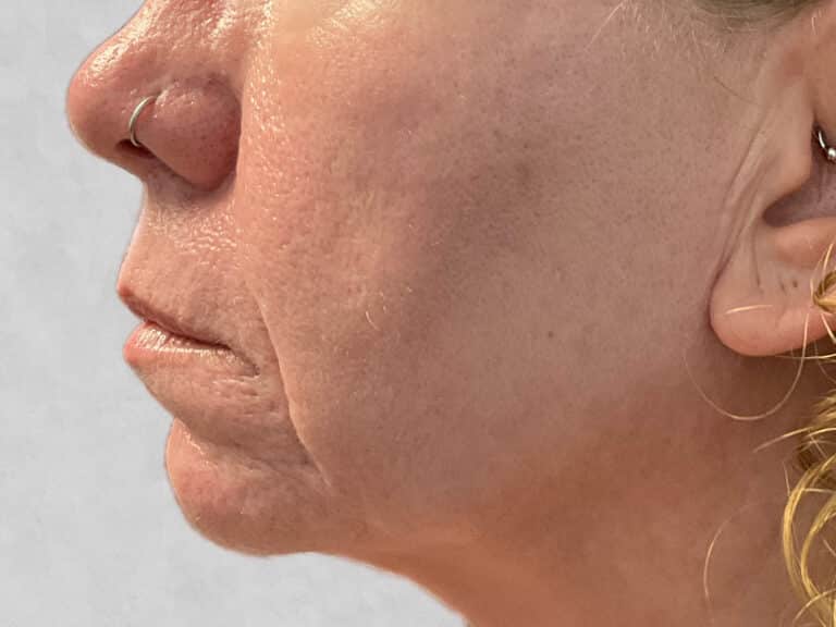 After Image: Microneedling & Laser – Jade - left-side