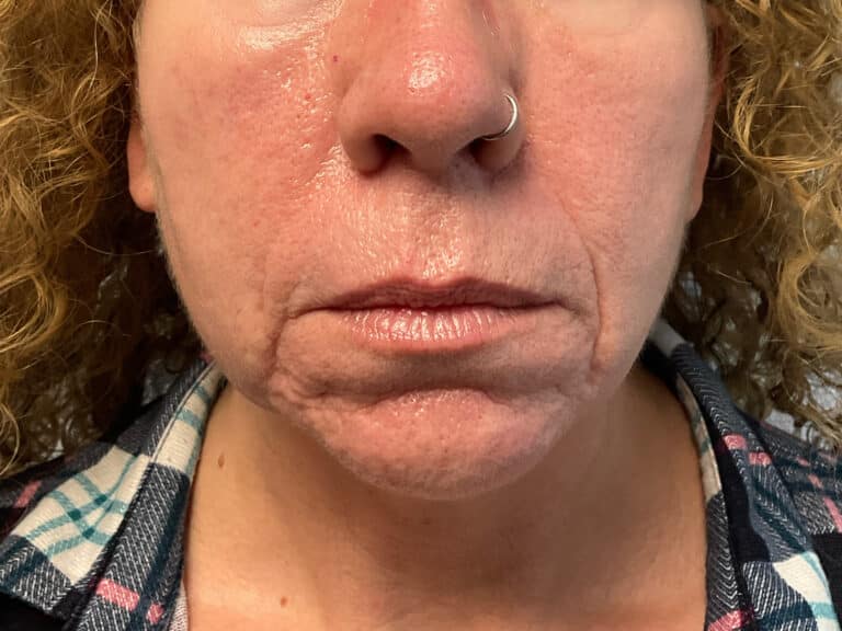 After Image: Microneedling & Laser – Jade - front