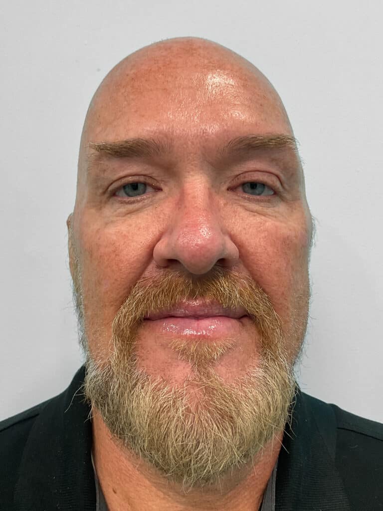 After Image: Botox – Heather - front