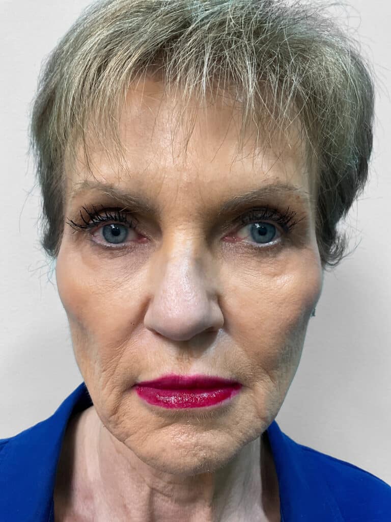 After Image: Filler – Heather - front