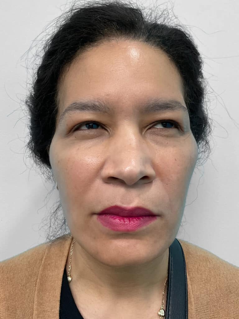 After Image: Injectables – Heather - front