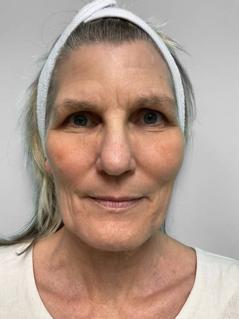 After Image: Microneedling & Laser – Jade - front