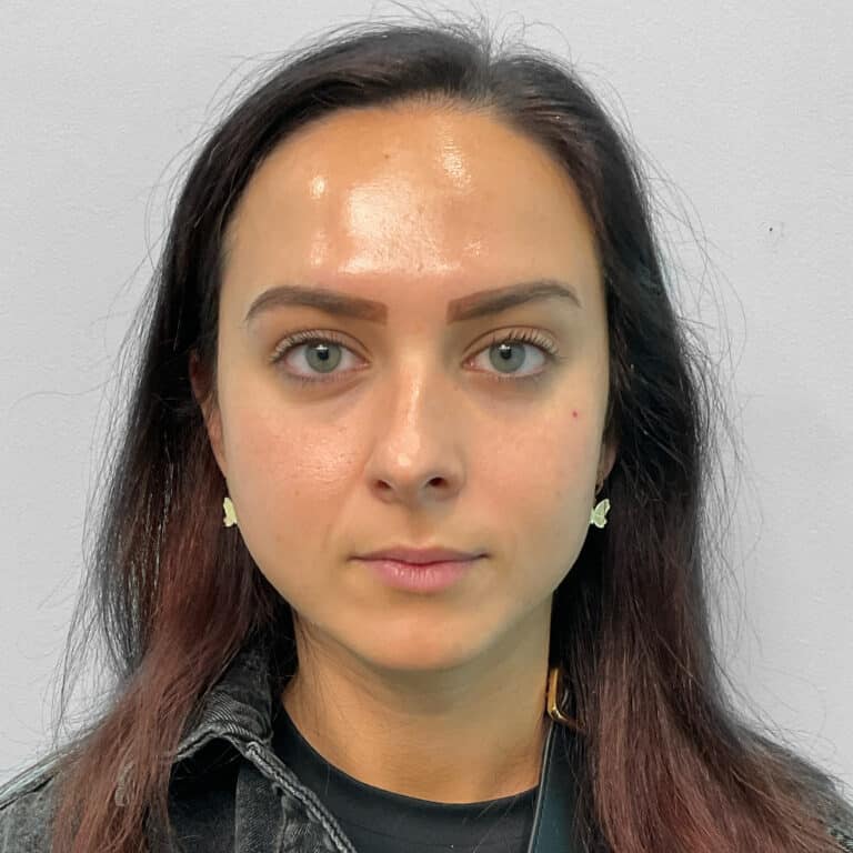 After Image: Botox – Joy - front