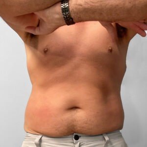After Image: Emsculpt – Jessica
