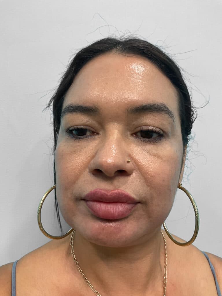 After Image: Restylane Kysse – Heather - front