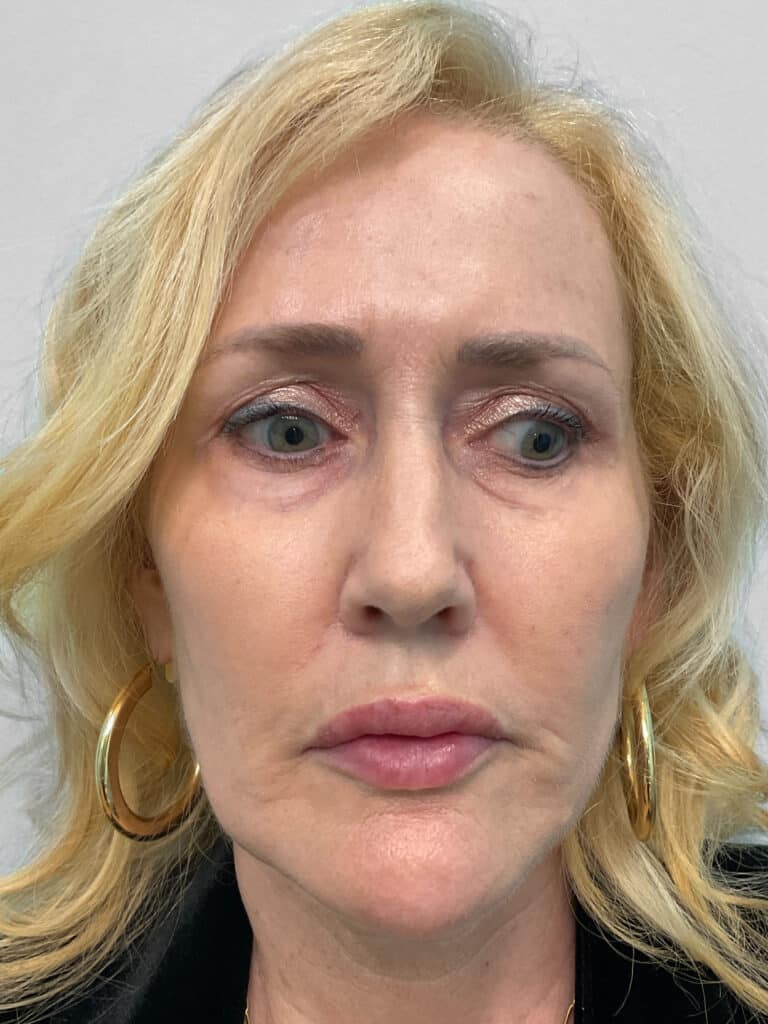 After Image: Filler – Heather - front