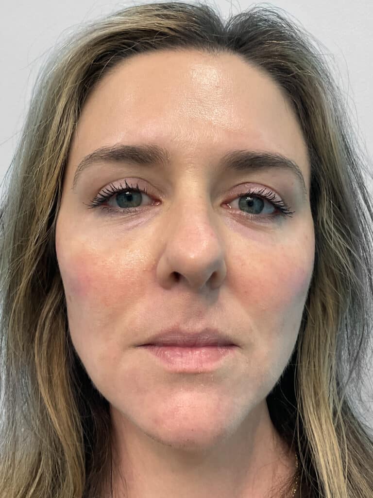 After Image: Filler – Heather - front