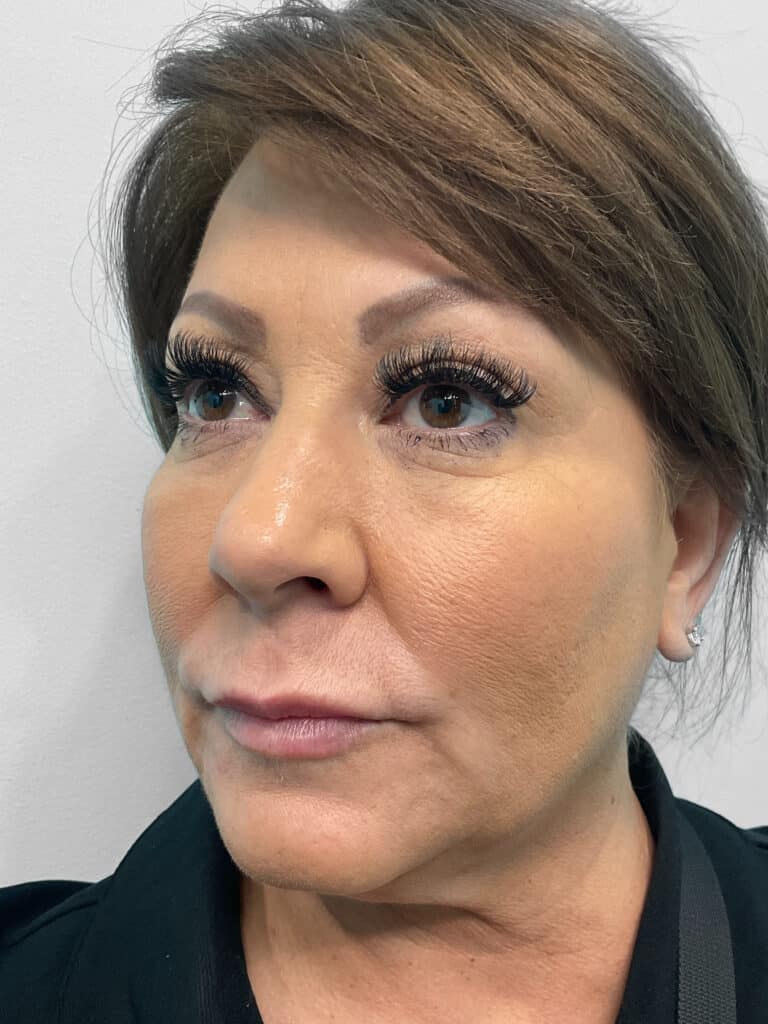 After Image: Restylane Kysse – Heather - left-front-oblique