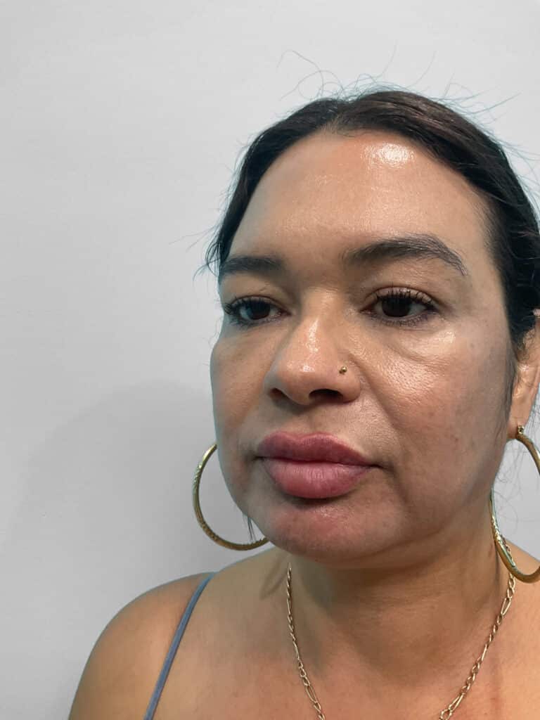After Image: Restylane Kysse – Heather - left-front-oblique