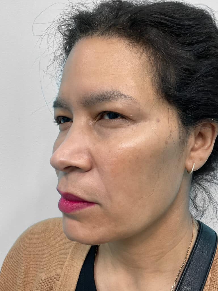 After Image: Injectables – Heather - left-front-oblique