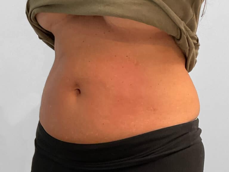 After Image: Emsculpt Neo – Jessica - left-front-oblique