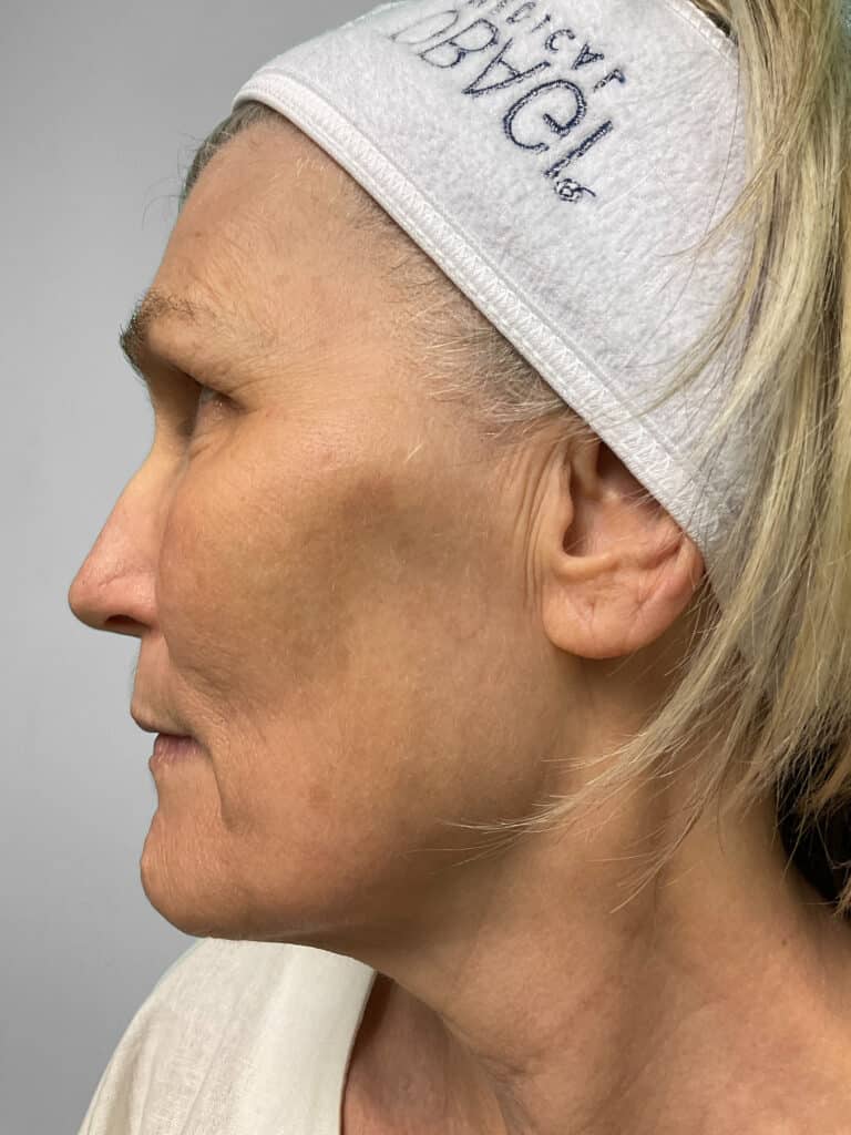 After Image: Microneedling & Laser – Jade - left-side
