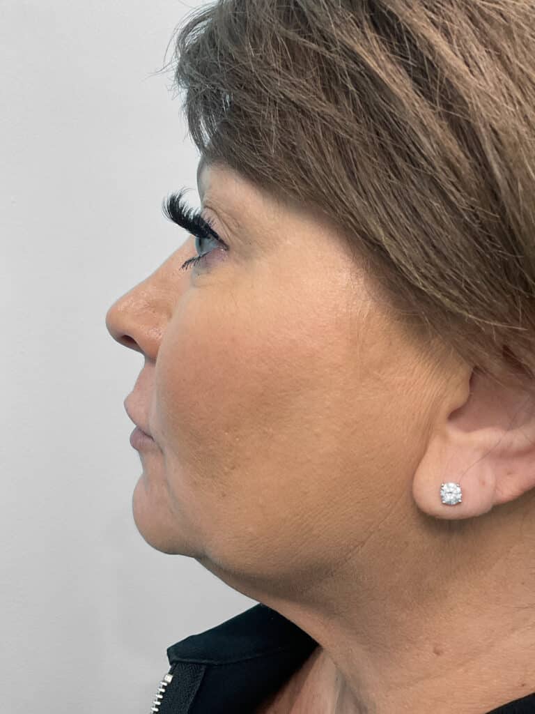 After Image: Restylane Kysse – Heather - left-side