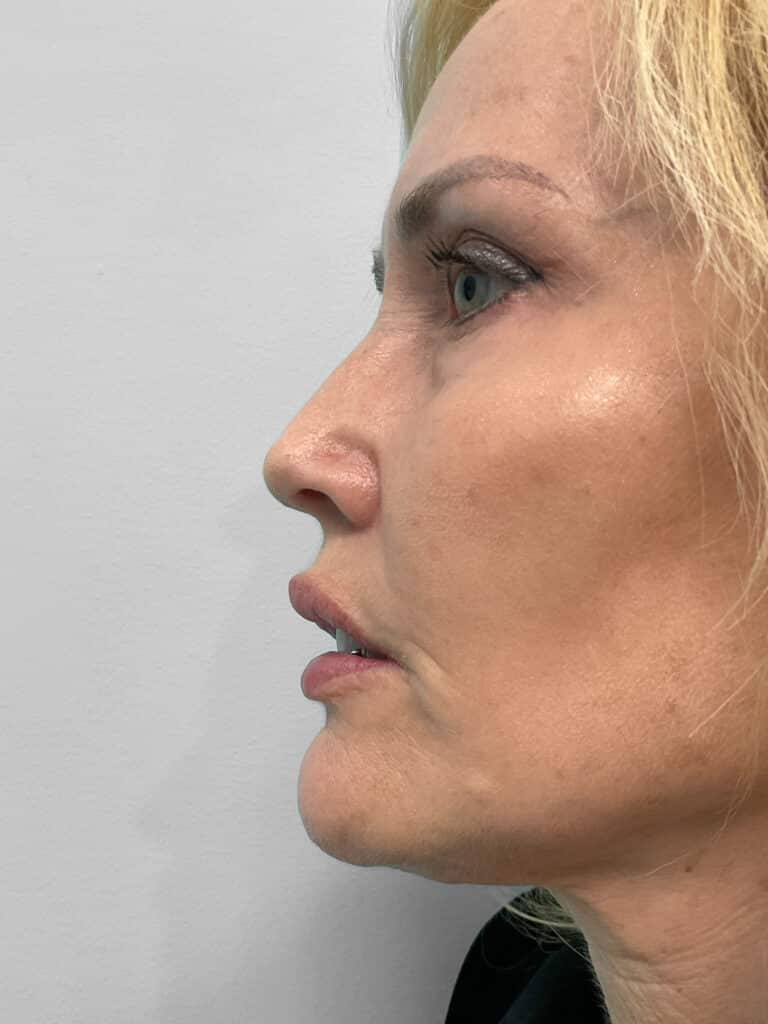 After Image: Filler – Heather - left-side