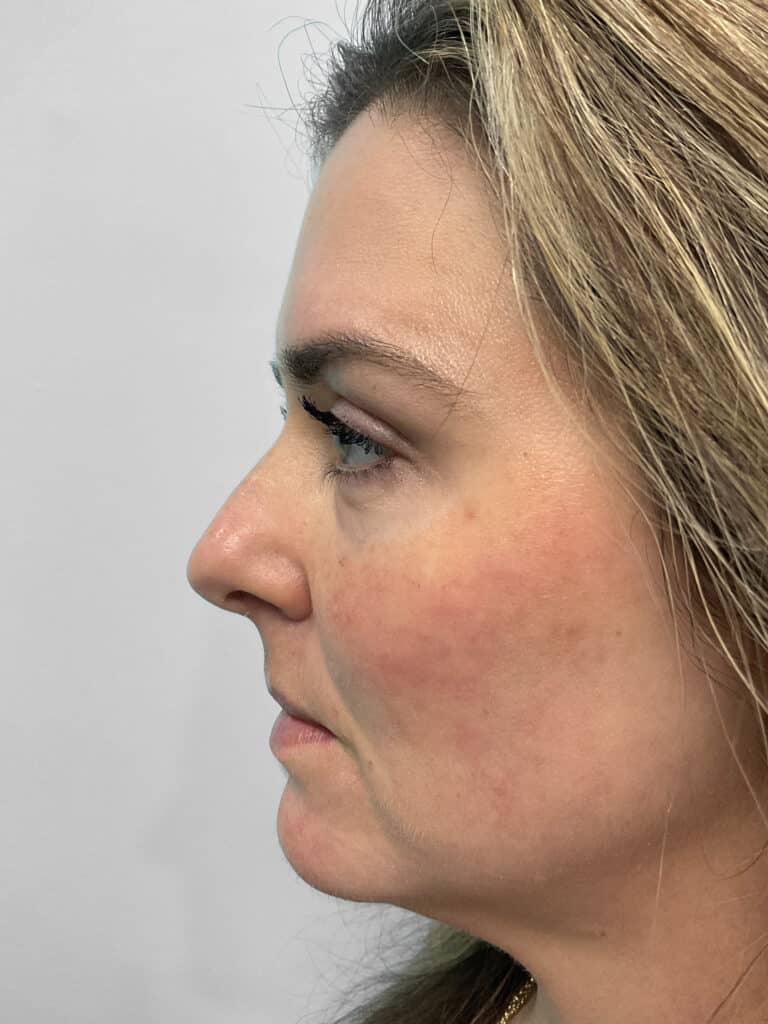 After Image: Filler – Heather - left-side