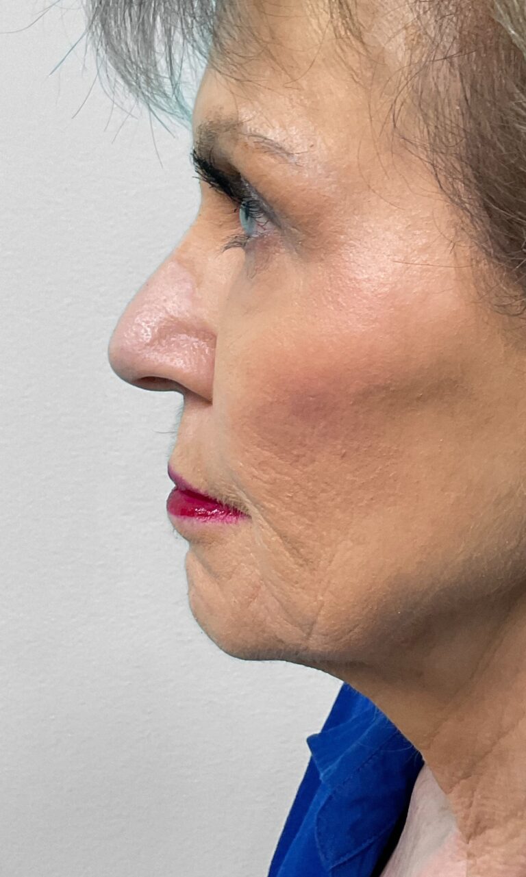 After Image: Filler – Heather - left-side