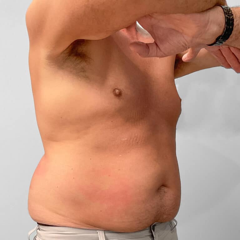 After Image: Emsculpt – Jessica - right-front-oblique
